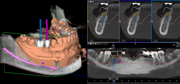 navigierte Implantation